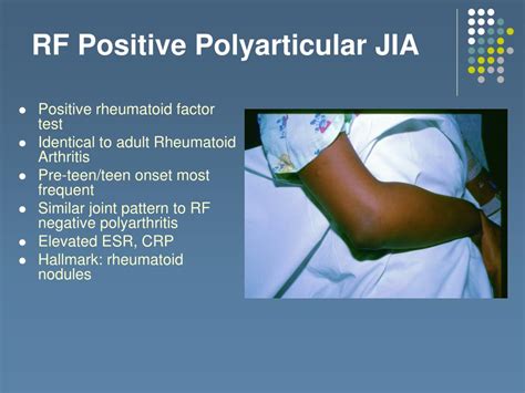 how often is rf negative